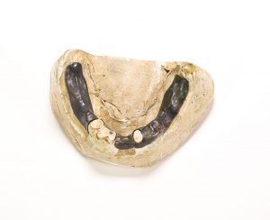 Photograph of a plaster cast of inferior dentition